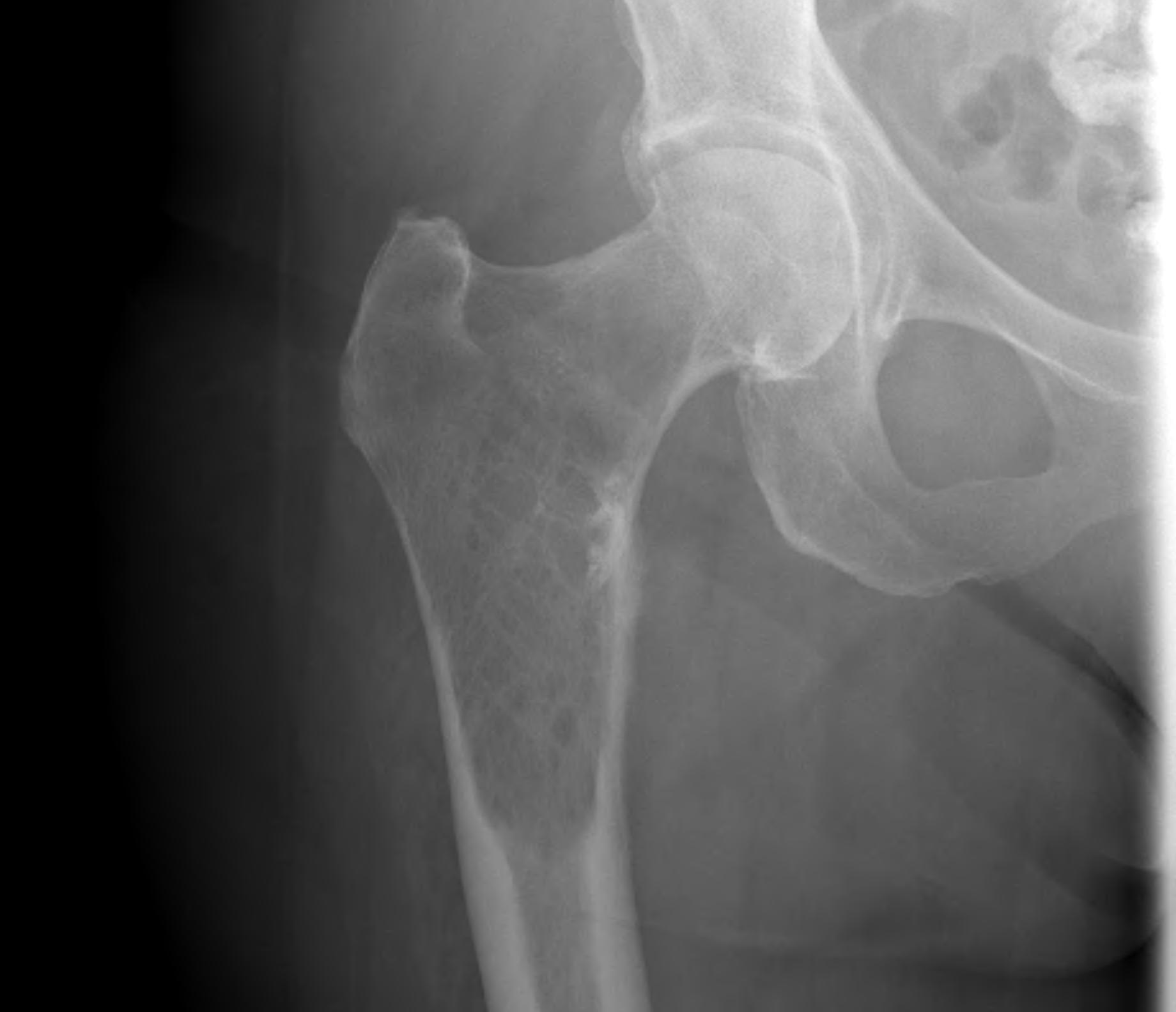 Metastasis Proximal Femur